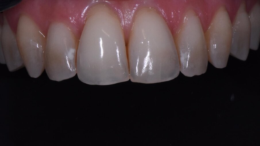 Fig. 7 - Incompetenza labiale ed esposizione delle superfici dentali.