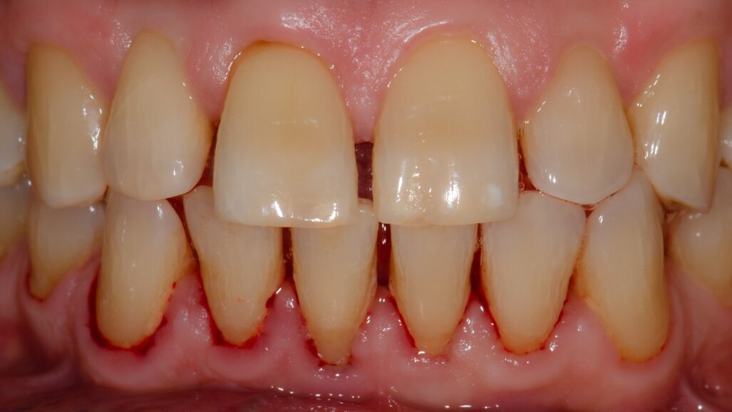 The intersection of technology: Guided implant surgery and 3D printing