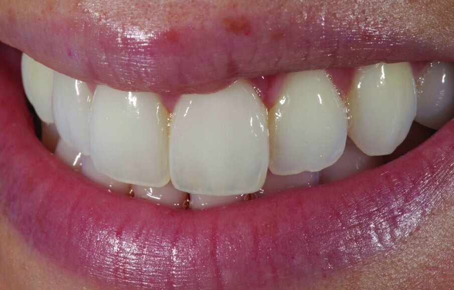 Fig. 8, 9 and 10: The completed crown on the model.