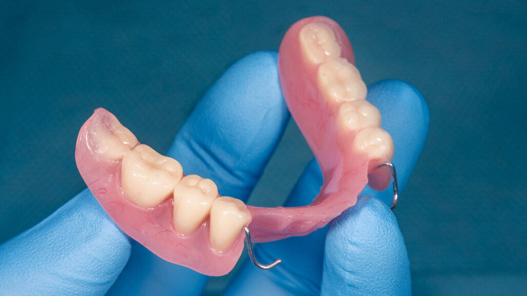 Removable partial dentures may improve mortality among partially edentulous adults