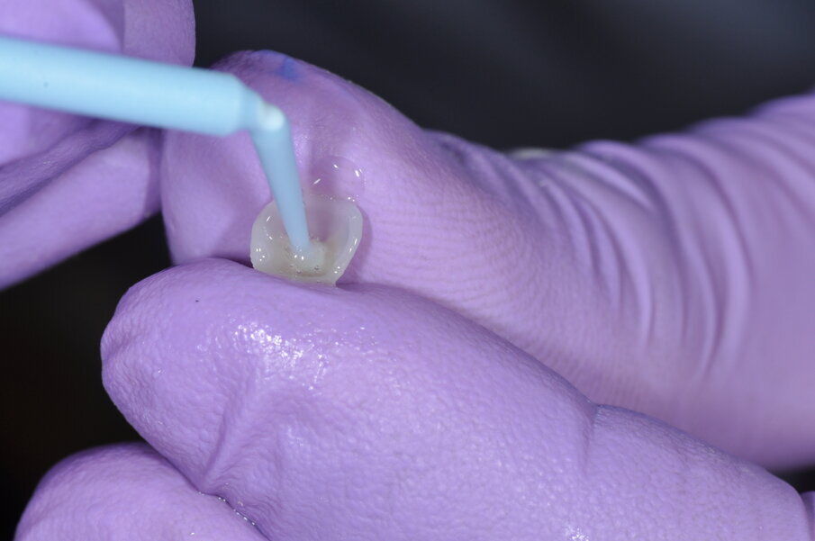 Fig. 5: Edelweiss Veneer Bond applied to inner surface of the pediatric crown, air dried and light cured.