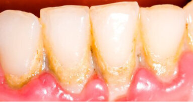 Nový výzkum zjistil významnou souvislost mezi chronickou parodontitidou a cévní mozkovou příhodou