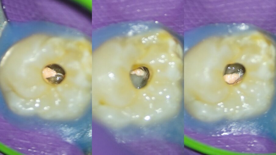 Figs. 8a–c: Root canal entrances obturated and pulp chamber oor cleaned palatal (a), mesiobuccal (b) and distobuccal (c).