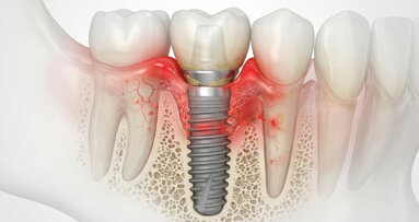 Diabetes associated with poorer long-term dental implant outcomes