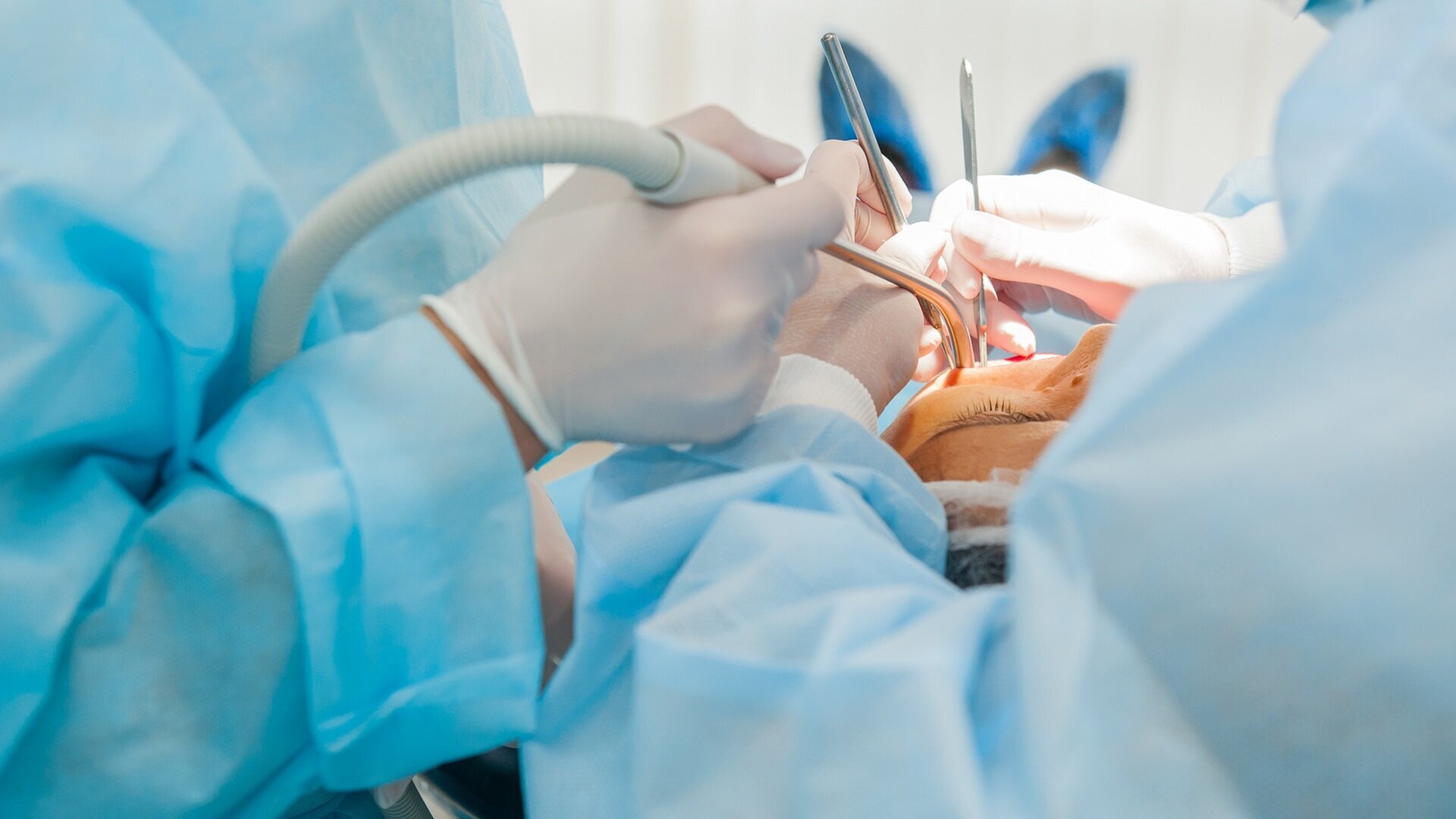 3D-printed screw-retained single crown: A chairside single-visit workflow