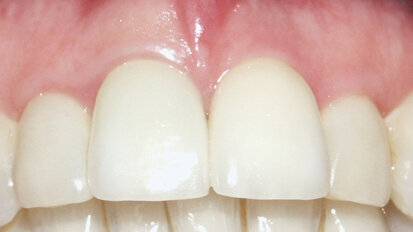 Immediate single-tooth replacement, provisionalization Immediate single-tooth replacement, provisionalization