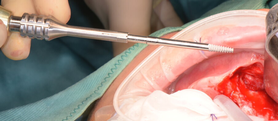 Figg. 20-23 - Impianto zigomatico AoN: notare la posizione extrasinusale con il mantenimento del picco osseo crestale.