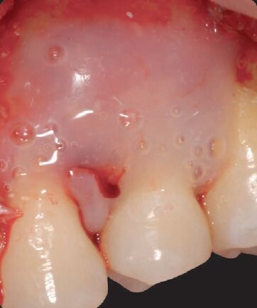 Figg. 7, 8 - Difetto riempito con Biomateriale (Rebone© – UBGEN) e amelogenine (Emdogain).