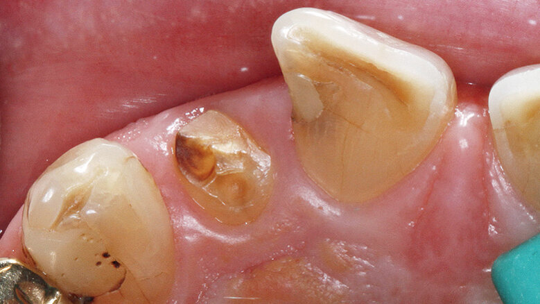 Keramické implantáty: Včera vize, dnes reálná výzva?