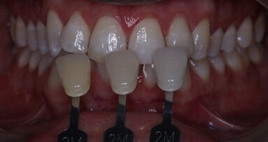 A less destructive method to whiten teeth developed in China