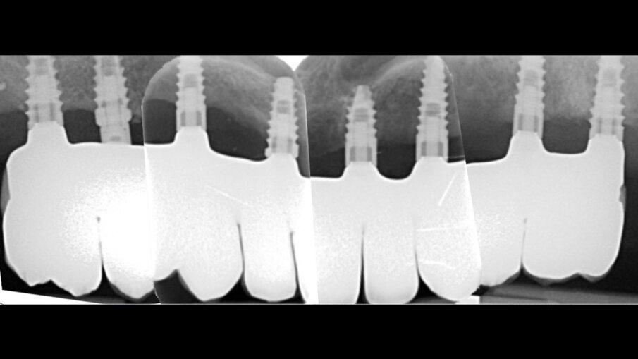 Obr. 12a, b: Intraorální snímek (a) a periapikální RTG snímek (b) definitivní náhrady.