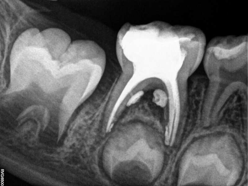 Fig. 3 : Trois canaux, obturation canalaire latérale.