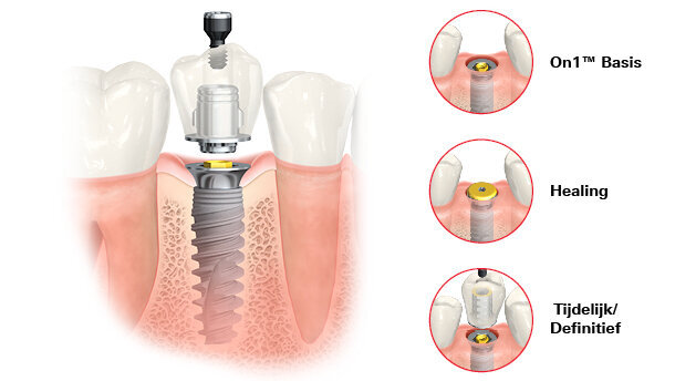 On1™ combineert het beste van twee werelden.