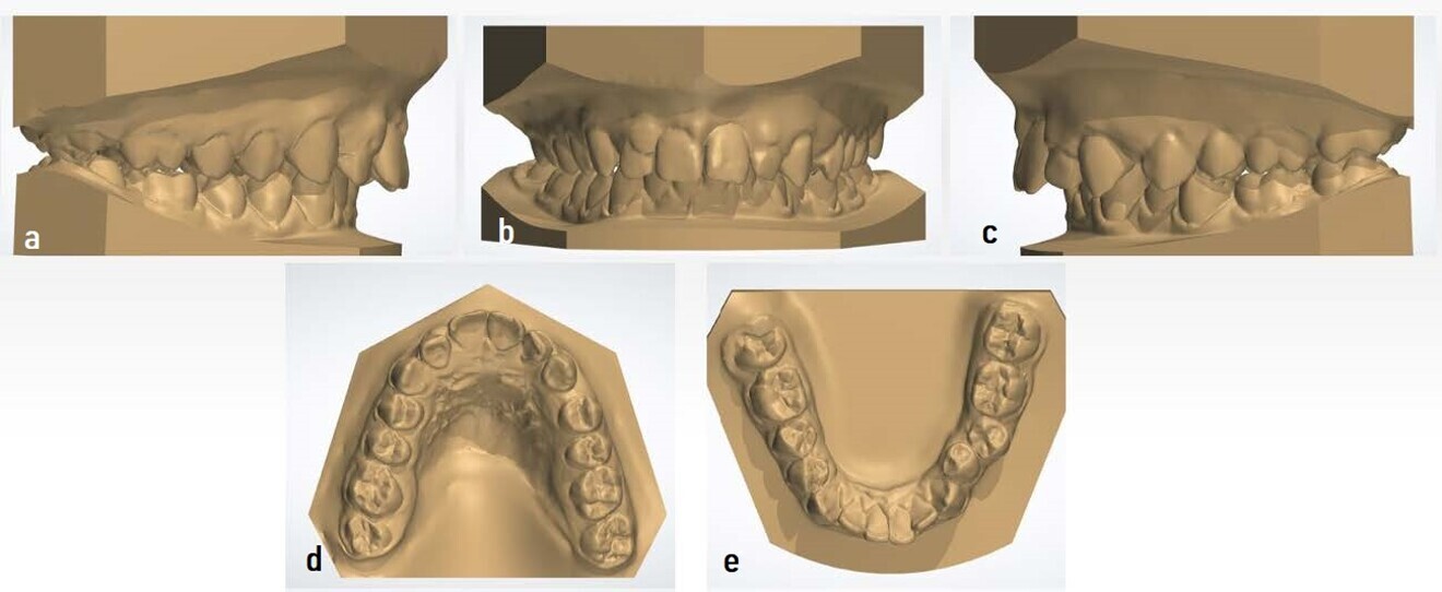 Figs. 12a–e: Digital models taken after removal of the Class II Carriere Motion Appliance. 