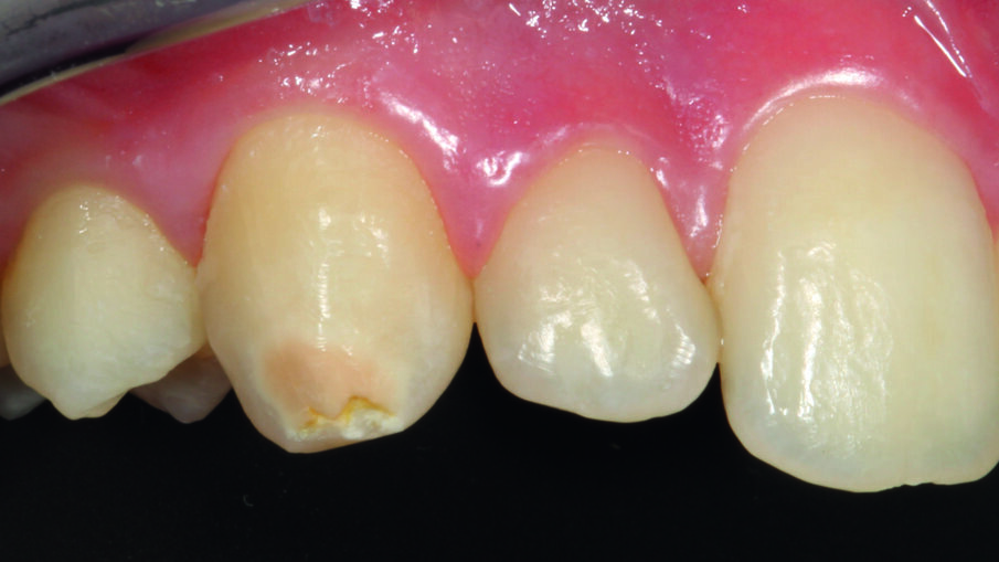 Afbeelding 8. Beginsituatie: esthetisch storende glazuurvorming op element 13 na melktandtrauma in de kindertijd.