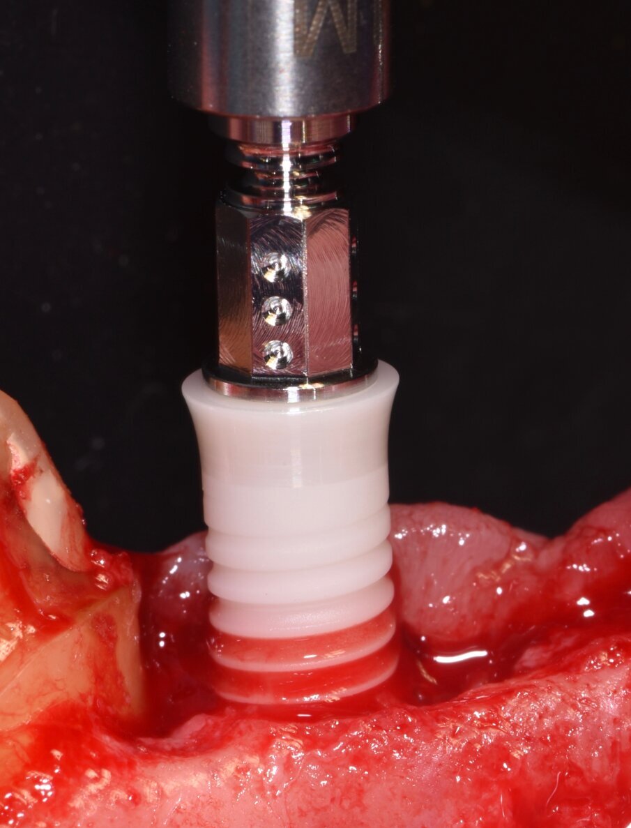 Fig. 22_Questo dettaglio evidenzia la caratteristica della superficie implantare che aumentando l’idrofilia aumenta la bagnabilità dell’intero impianto con una più veloce capacità osseo integrativa.