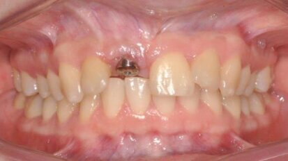 Odbudowa ubytku kostnego w szczęce allogennym blokiem kostnym z PRP