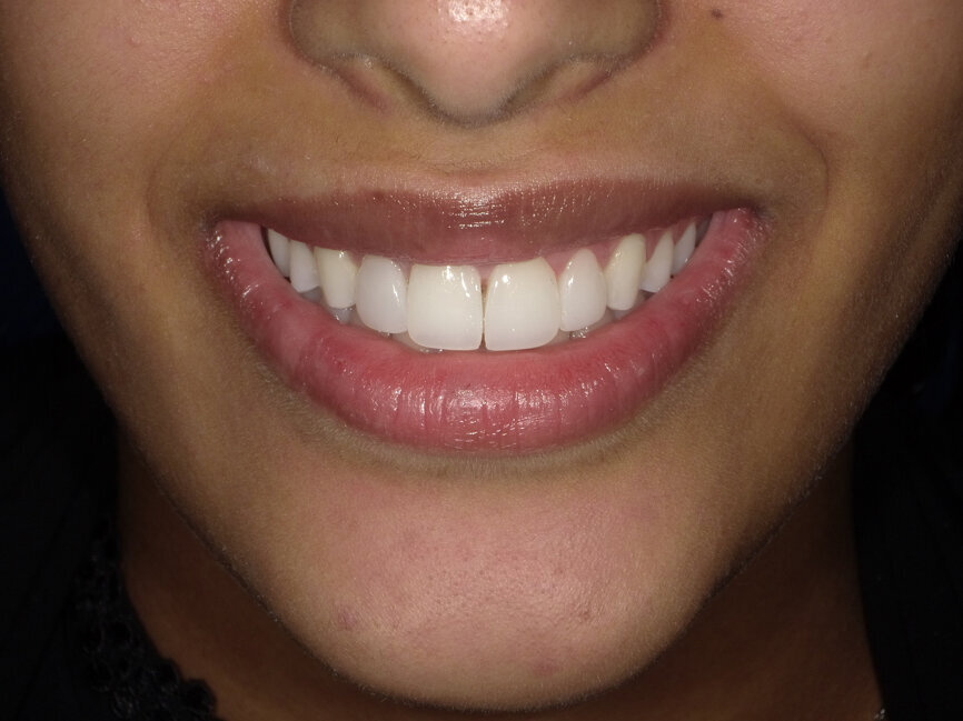 Fig 15: Patient smile post treatment 