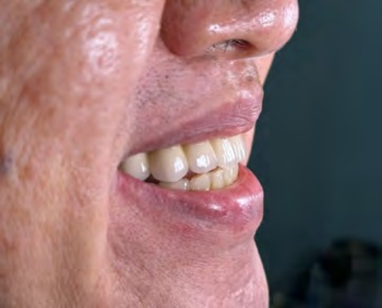 Fig. 3k: Right oblique smile view illustrating the functional and aesthetic integration of the definitive prosthesis.