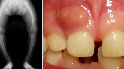 Une lueur d´espoir dans le traitement du rachitisme