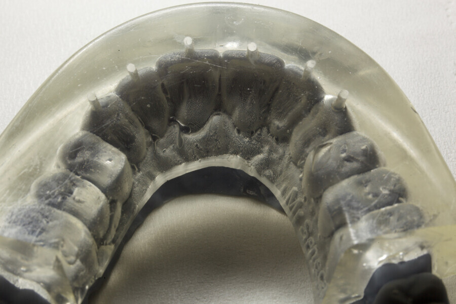 Fig. 6: Silicone index produced over the wax-up model with injection channels at the incisal edges of each tooth to be restored.
