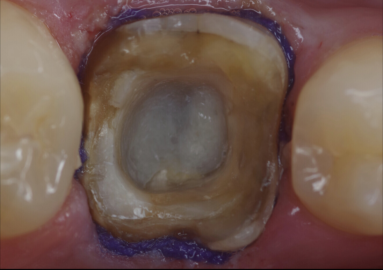 Fig. 11: Final preparation prior to taking the digital impression, for which retraction cord had been placed.