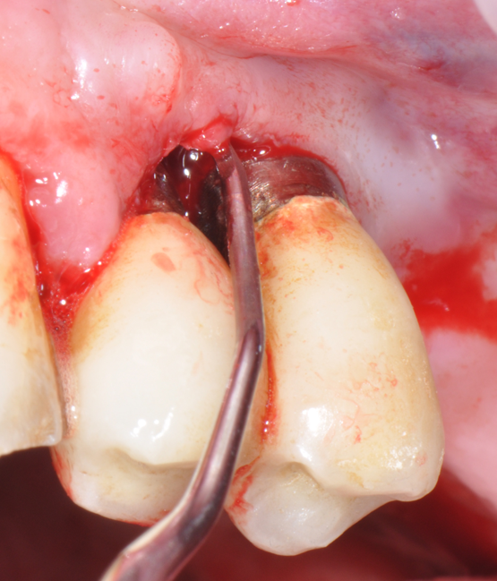 Fig.18: Case 2. Internal pocket line curettage.