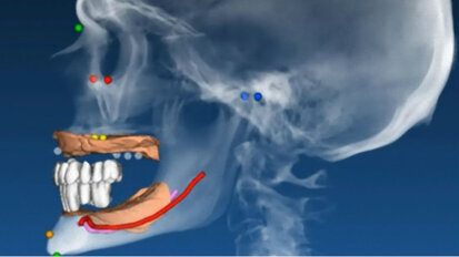 Quattro punti da non dimenticare nella programmazione implantare
