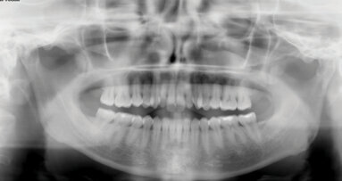 Řešení otevřeného skusu u dospělého pomocí Insignia™ systému a Straight-Wire™ finishingu