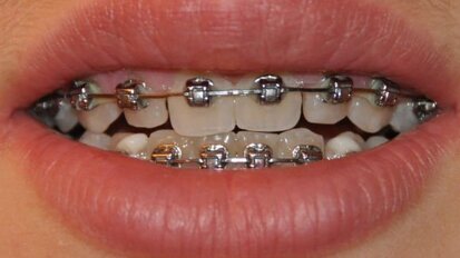 Raziskovalci  razvijajo nov izdelek dentalne nege, za oskrbo  ortodontskih pacientov