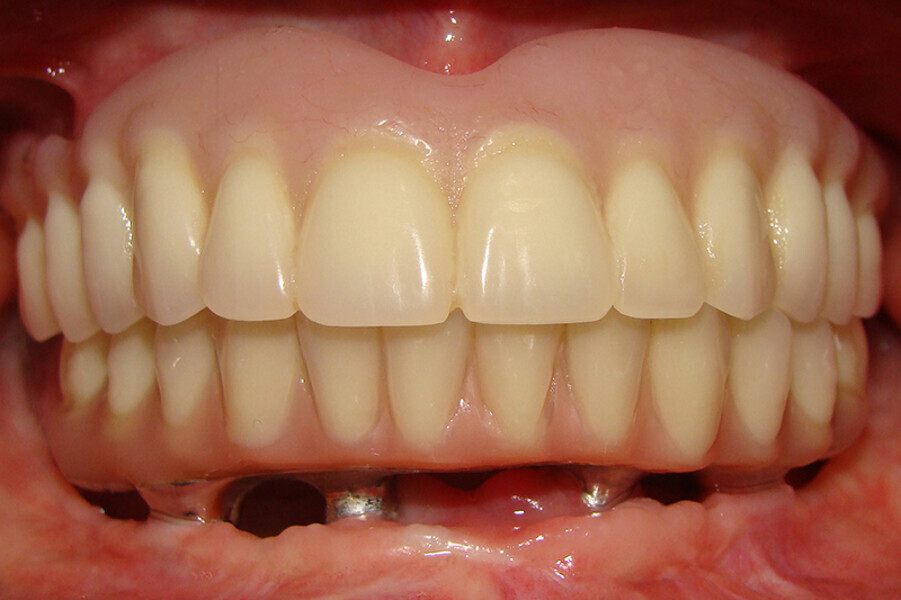 Fig. 10. Prótesis híbrida inmediata con 10 años de evolución y Rx Control a los 10 años.