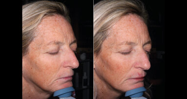 Bio-ristrutturazione palpebrale