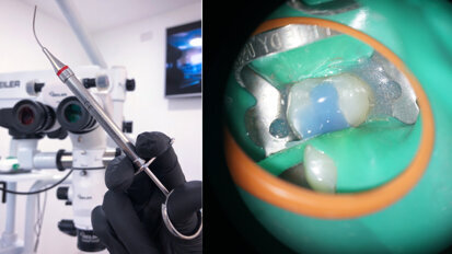 Unmittelbare Pulpa-Überkappung als konservatives Verfahren zum Erhalt der Pulpenvitalität Unmittelbare Pulpa-Überkappung als konservatives Verfahren zum Erhalt der Pulpenvitalität