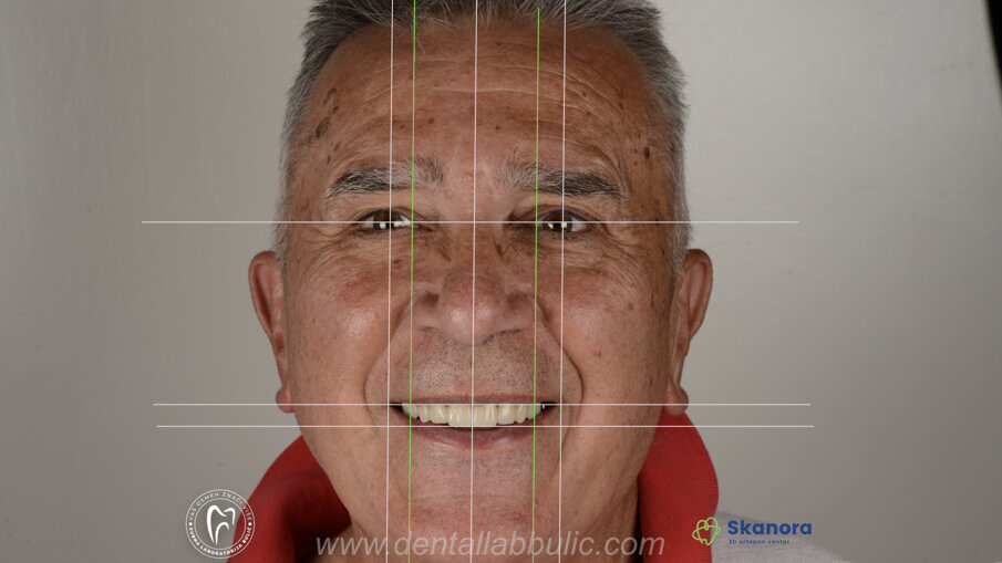 Slika 6-002 izgled definitivnog rada u ustima 