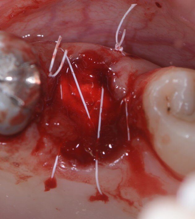 Fig. 6 - Spugna di collagene e suture.