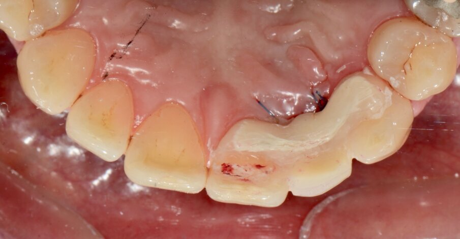 Fig. 6: Acrylic provisional restoration in place on the day of surgery. 