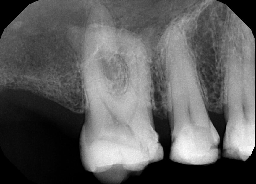 Fig. 18a: Note the expert management of the apical constriction and the acute curvature of the MB root. (Courtesy of Dr. Nestor Cohenca)