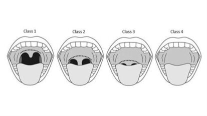 Trattamento dei disturbi del sonno con Laser Er:YAG Fotona