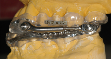 Apnoe- und Protusionsschienen helfen Schnarchern