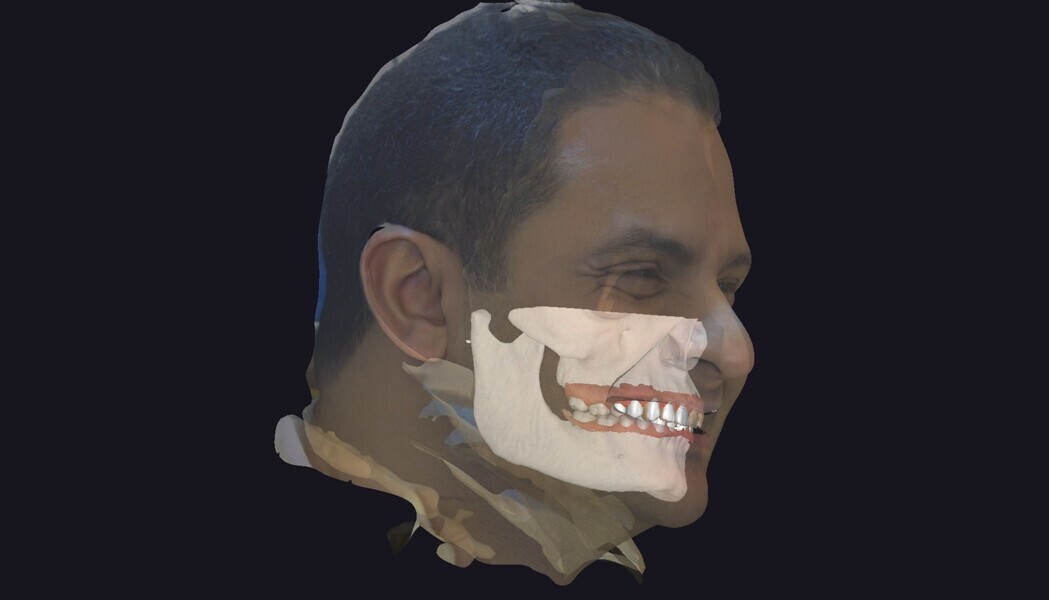 Fig. 3: This lateral profile view combines the facial scan and 3D skeletal data. The smile design was validated in harmony with the facial projection and aesthetic profile.