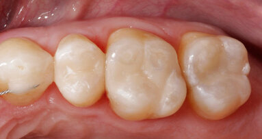 Nano-hybrid composites rank high in clinical study