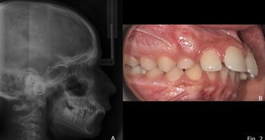 Il twin-block come stimolo funzionale alla risoluzione delle II classi scheletriche da retrusione mandibolare