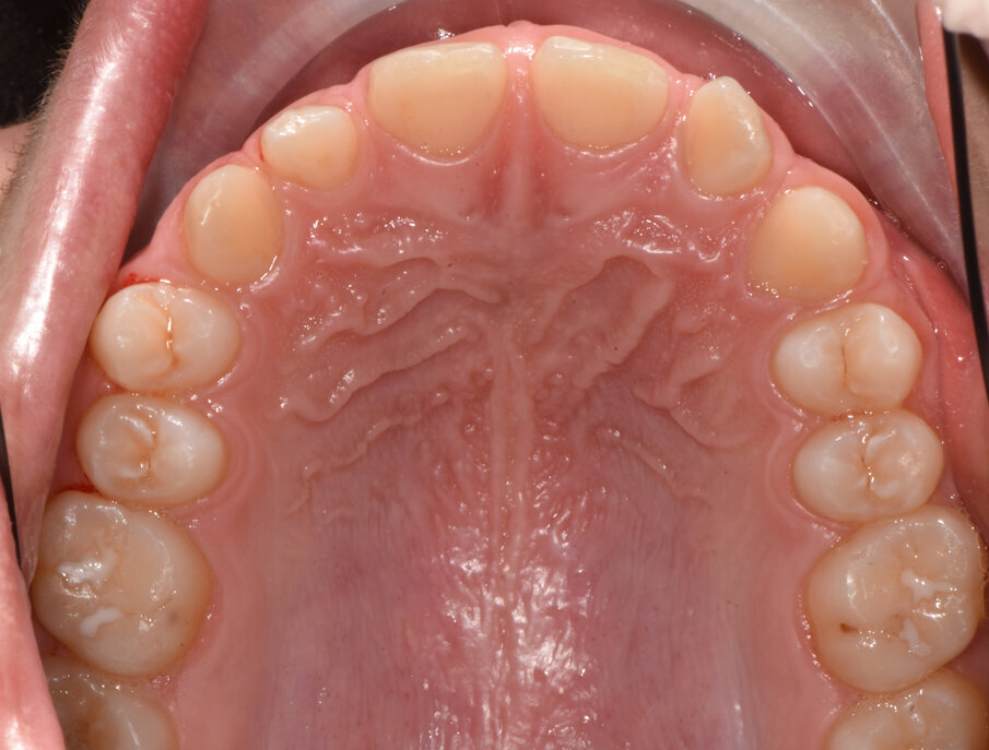 Fig. 29_Percorso eruttivo dei canini completato.