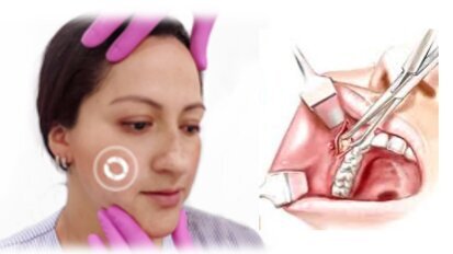 Datos importantes y riesgos de la bichectomía