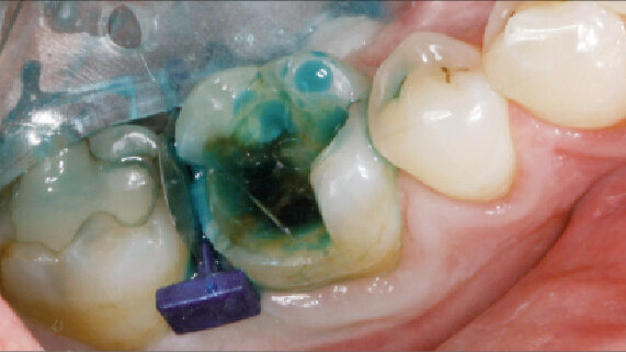 Korunka nebo onleje zhotovené v jeden den – ukázka klinického případu (Výhody nepřímých kompozitních náhrad)