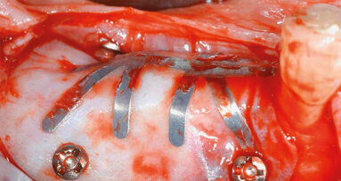 Procedura di incremento osseo verticale con tecnica GBR