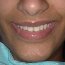 Meeting patients' needs and transforming smiles with direct veneers