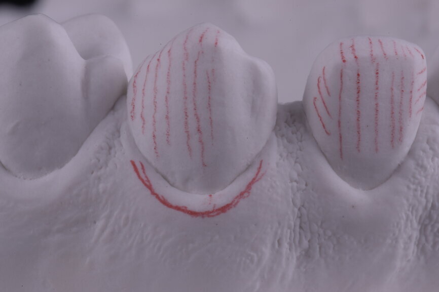 Fig. 45: Surgical silicone index for crown lengthening and cervical contours marked with a red pencil.