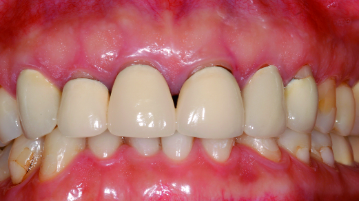 Changing grey–white back to red–white