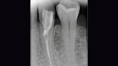 Fig. 2. Estado tras la revisión, la colocación de la espiga y la reconstrucción. Fig. 2. Estado tras la revisión, la colocación de la espiga y la reconstrucción.